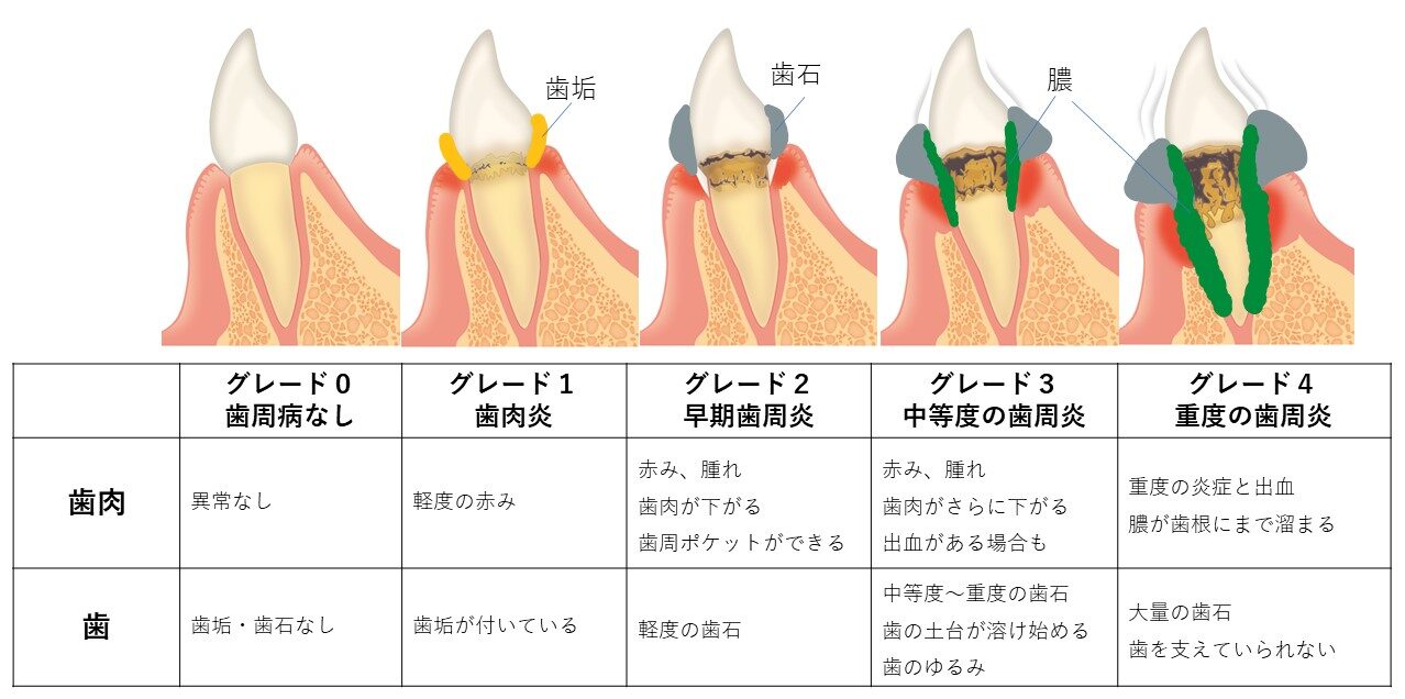 歯根膿瘍の症状01